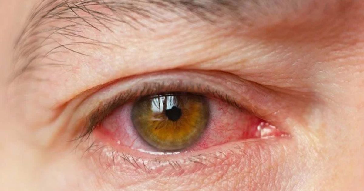 Đôi mắt của bạn có thể bị cộm, xốn và sưng đỏ