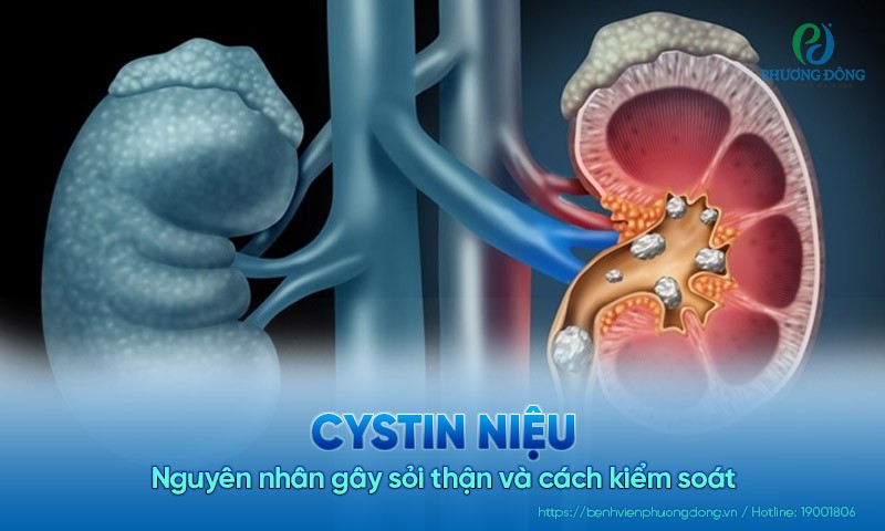 Cystin niệu: Nguyên nhân gây sỏi thận và cách kiểm soát