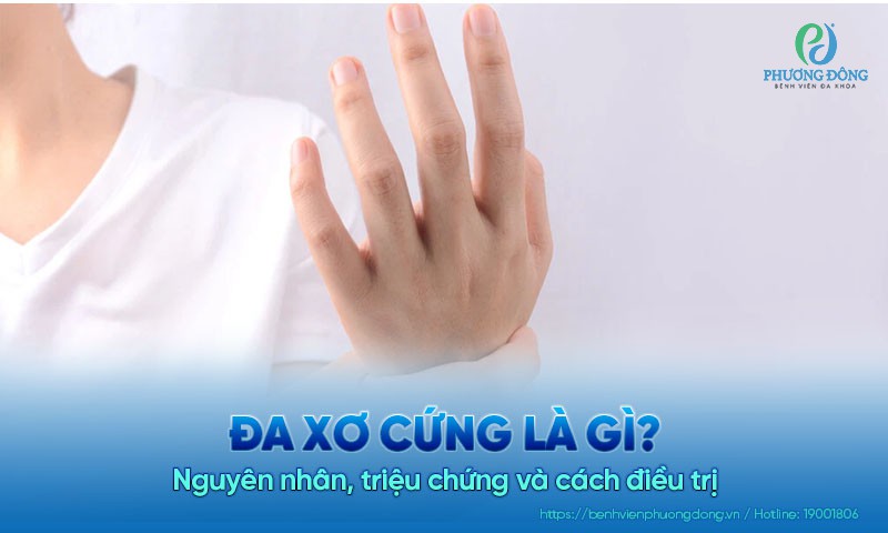 Đa xơ cứng là gì? Nguyên nhân, triệu chứng và cách điều trị