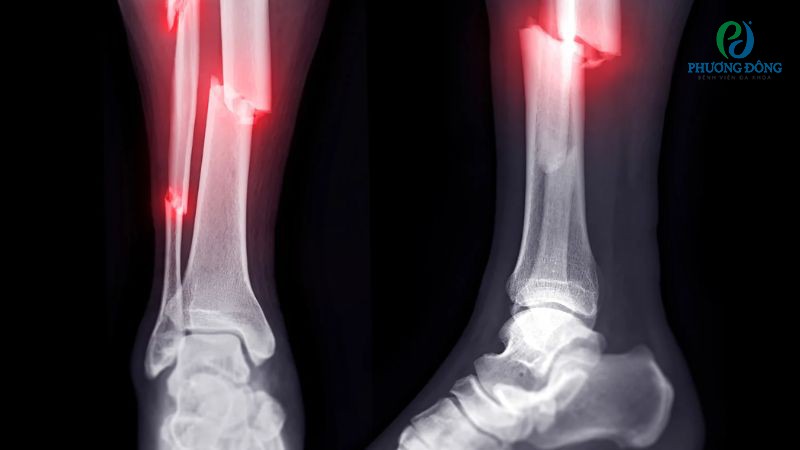 Mất tính ổn định mỗi khi thử cử động cơ thể, đặc biệt vùng gãy xương