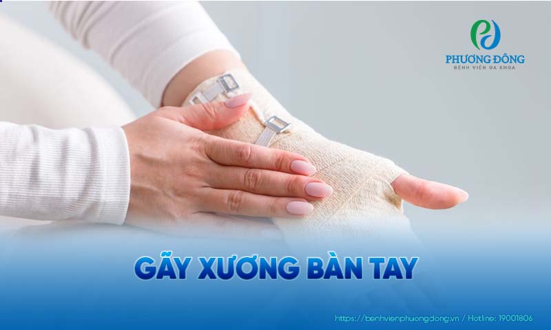 Xương bàn tay bị gãy có thể ảnh hưởng đến khả năng cầm nắm của người bệnh