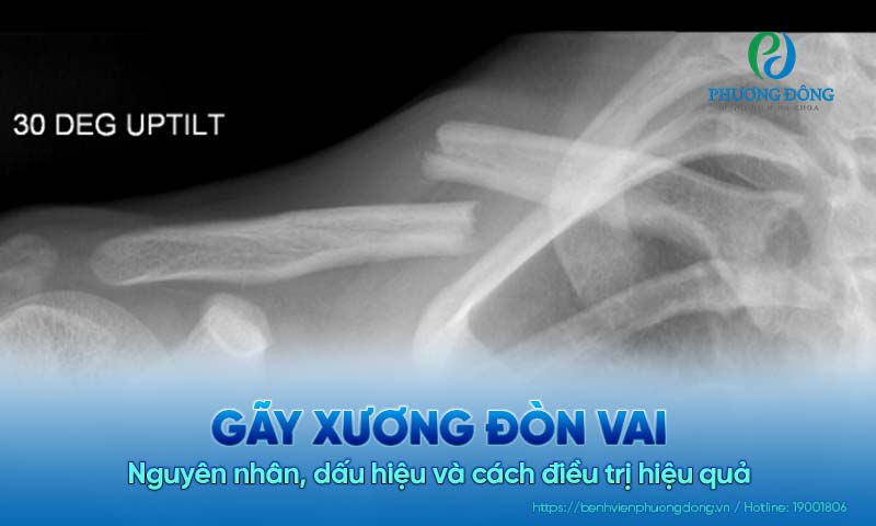 Gãy xương đòn vai: Nguyên nhân, dấu hiệu và cách điều trị hiệu quả