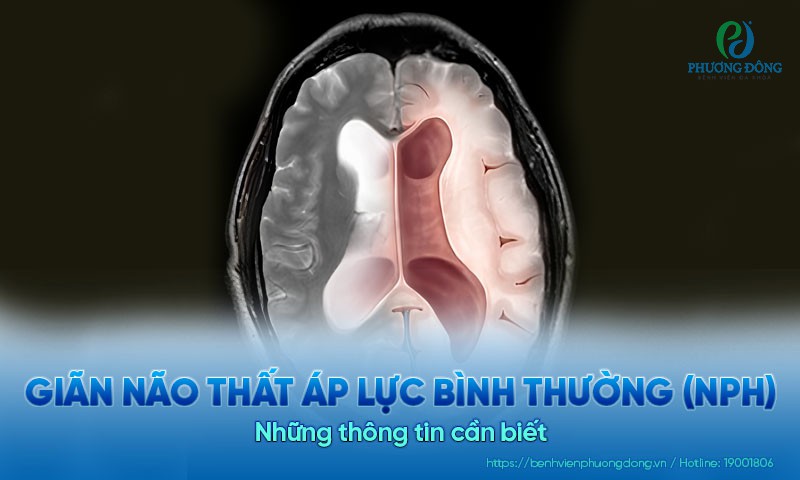 Giãn não thất áp lực bình thường (NPH) - Những thông tin cần biết