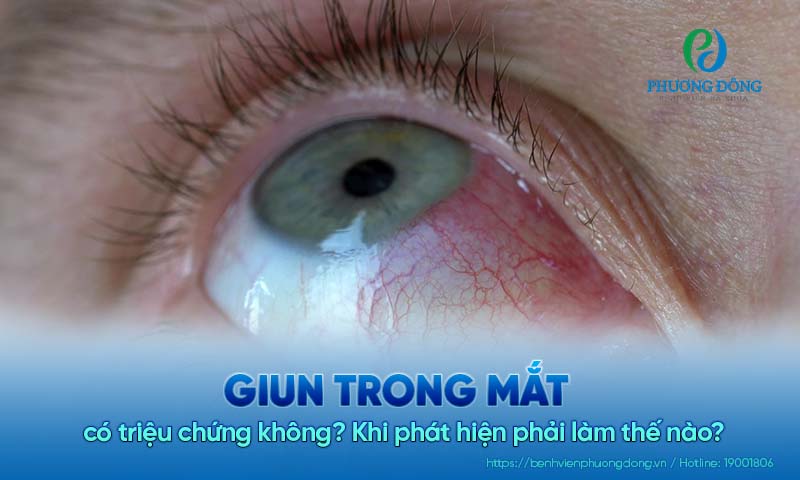 Giun trong mắt có triệu chứng không? Khi phát hiện phải làm thế nào?