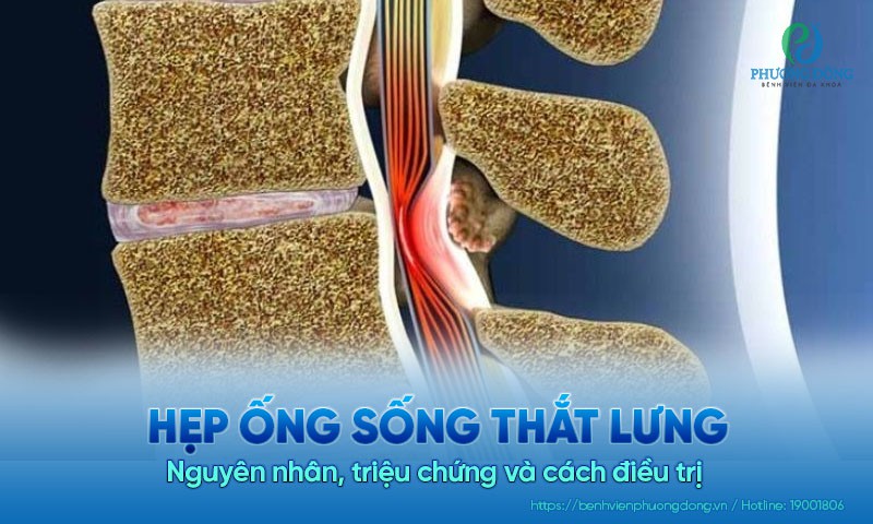 Hẹp ống sống thắt lưng: Nguyên nhân, triệu chứng và cách điều trị 