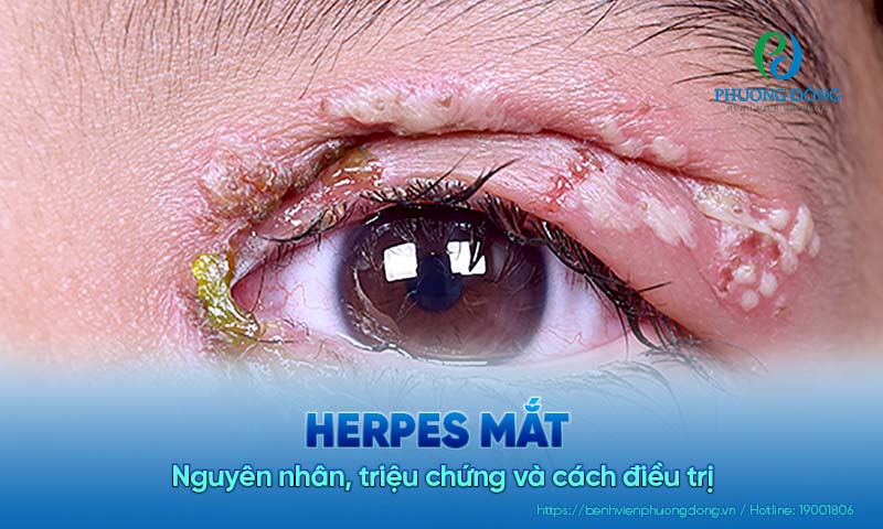 Herpes mắt: Nguyên nhân, triệu chứng và cách điều trị 