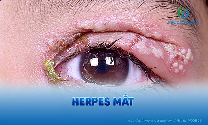 Virus Herpes tấn công trực tiếp vào vùng mắt sẽ gây ra tình trạng mụn rộp ở mắt