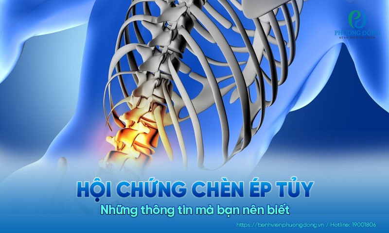 Hội chứng chèn ép tủy - Những thông tin mà bạn nên biết