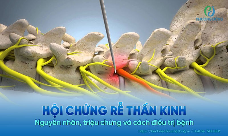 Hội chứng rễ thần kinh: Nguyên nhân, triệu chứng và cách điều trị bệnh