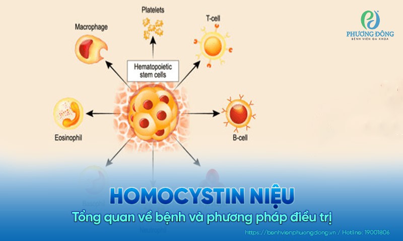 Homocystin niệu: Tổng quan về bệnh và phương pháp điều trị