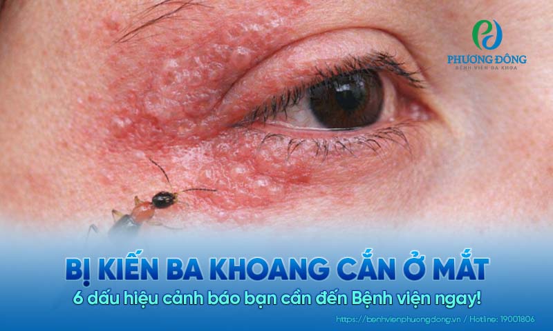 Bị kiến ba khoang cắn ở mắt: 6 dấu hiệu cảnh báo cần đến Bệnh viện ngay!