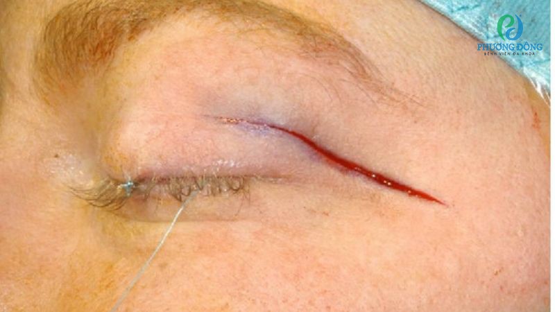 Một số phương pháp điều trị lồi mắt nặng do bệnh basedow