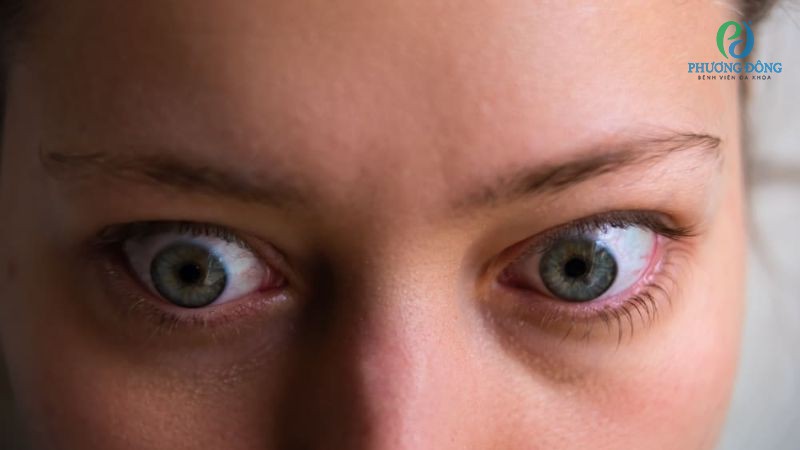 Dấu hiệu nhận biết mắt bị lồi do bệnh lý basedow