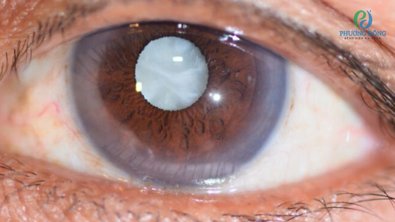 Dấu hiệu nhận biết mắt bị thoái hóa sớm và đang ở mức độ nghiêm trọng