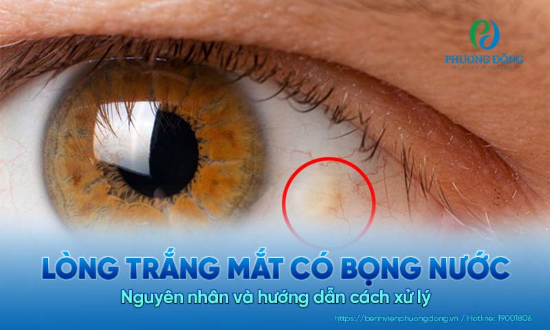 Lòng trắng mắt có bọng nước: Nguyên nhân và hướng dẫn cách xử lý 