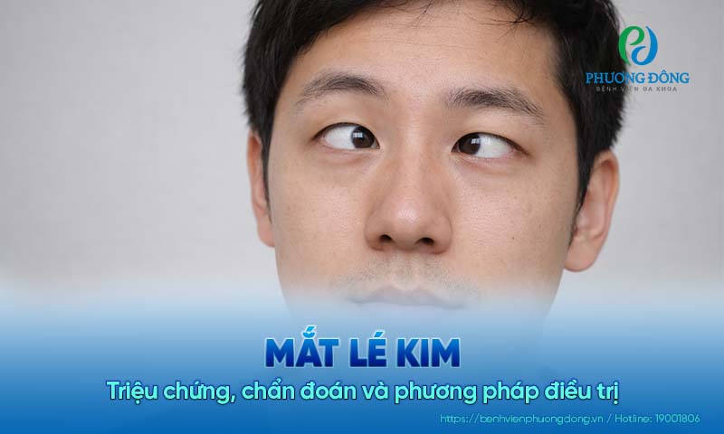 Mắt lé kim: Triệu chứng, chẩn đoán và phương pháp điều trị 