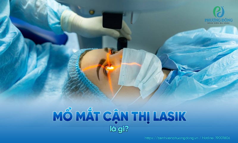 Mổ mắt cận thị LASIK: Ưu điểm, chỉ định và quy trình phẫu thuật