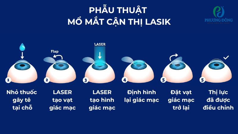 Quy trình các bước phẫu thuật mắt cận thị bằng kỹ thuật LASIK