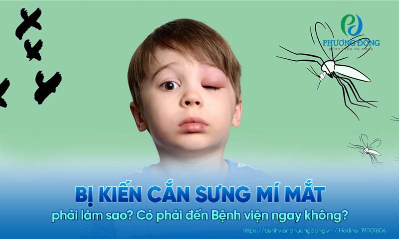 Bị kiến cắn sưng mí mắt phải làm sao? Có phải đến Bệnh viện ngay không?
