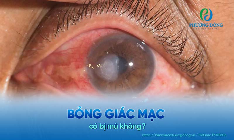 Hỏi đáp với bác sĩ chuyên khoa: Bỏng giác mạc có bị mù không?