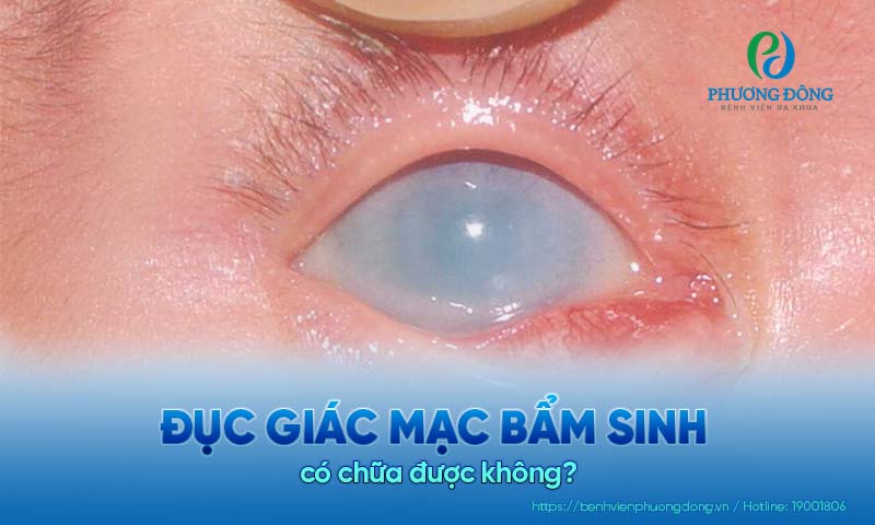 Bác sĩ chuyên khoa trả lời: Đục giác mạc bẩm sinh có chữa được không?