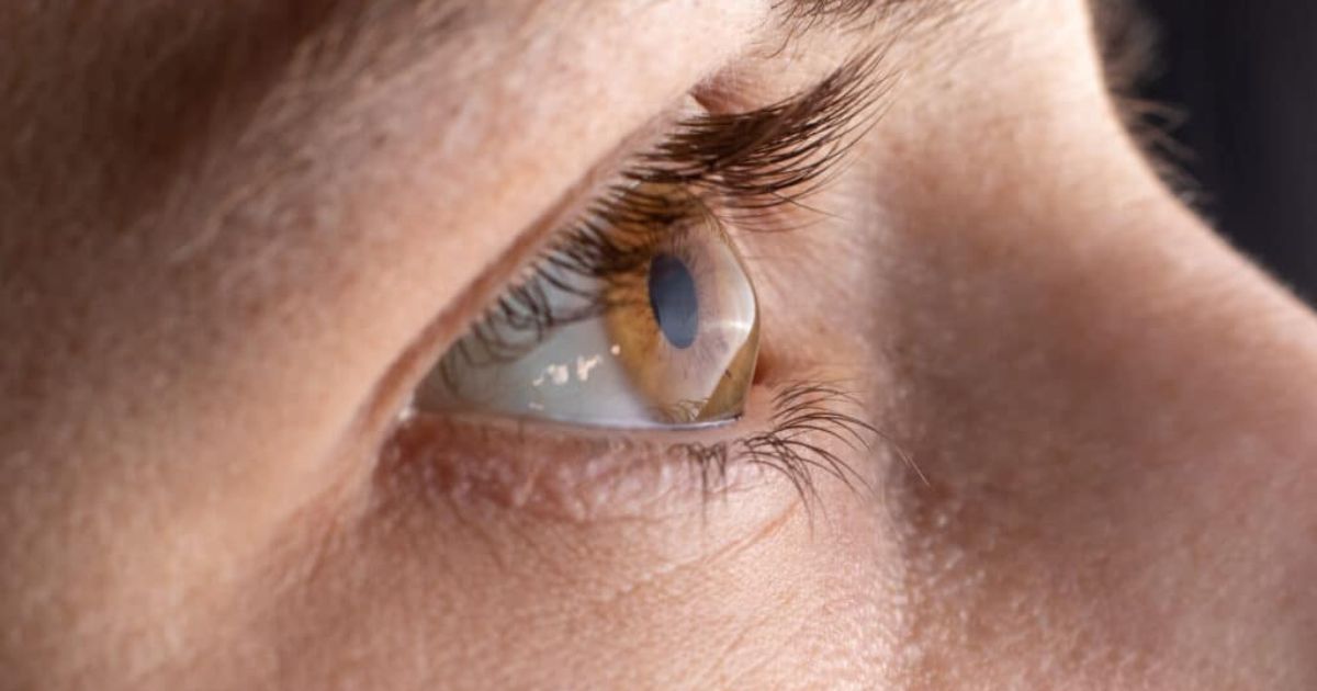 Giác mạc mỏng vẫn có thể mổ cận được nhưng phải theo sát chỉ định của bác sĩ 