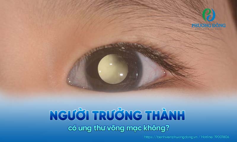 Người trưởng thành có ung thư võng mạc không? Tại sao? 
