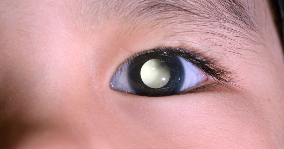 Ung thư võng mạc chủ yếu xuất hiện ở trẻ nhỏ, nguy cơ xuất hiện ở người trưởng thành khá thấp