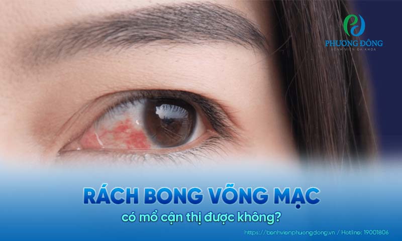 Bác sĩ chuyên khoa trả lời: Rách bong võng mạc có mổ cận thị được không?