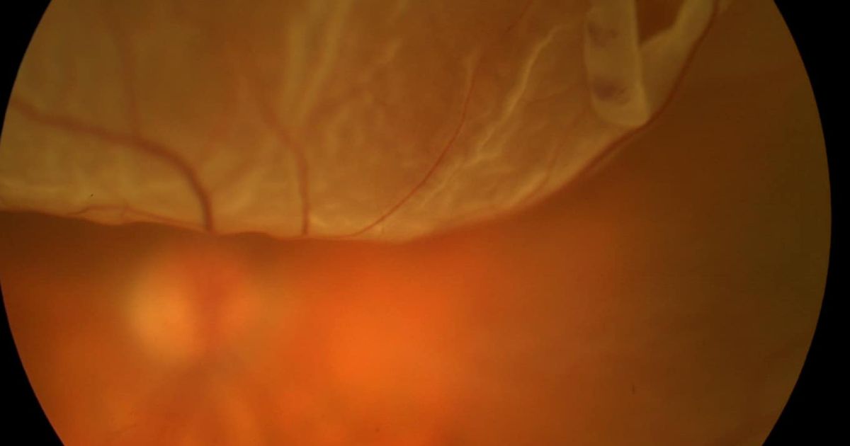 Người có triệu chứng bong võng mạc chưa được phẫu thuật ngay 