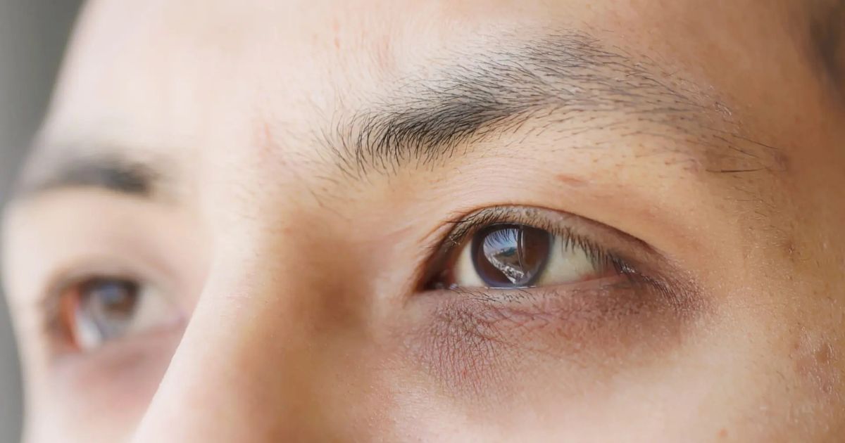 Có rất nhiều lý do khiến người bệnh có quầng thâm dưới mắt 