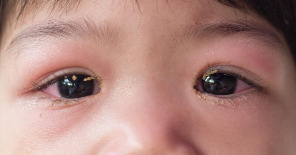 Trong trường hợp không mong muốn, bé có thể bị biến chứng viêm giác mạc 