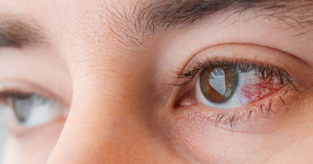 Nếu giác mạc chỉ viêm nhẹ thì bệnh có thể cải thiện sau 15 - 20 ngày 