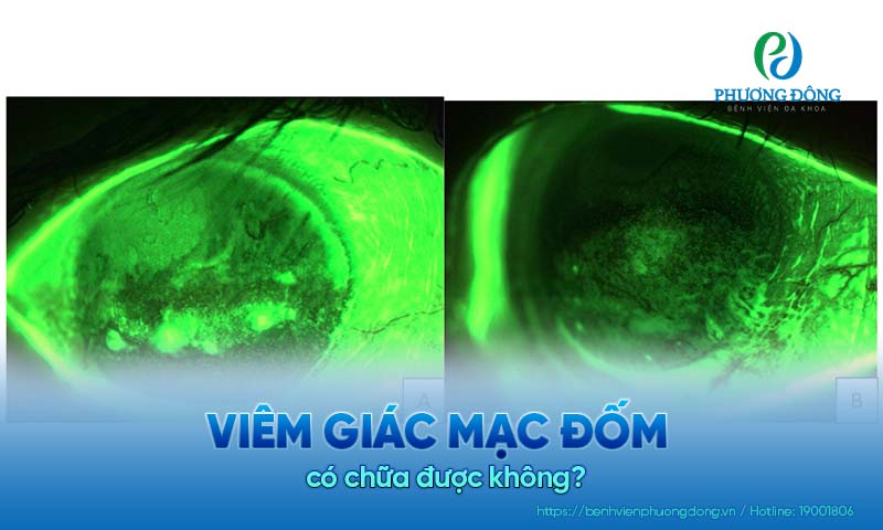 Giải đáp cùng bác sĩ: Viêm giác mạc đốm có chữa được không?