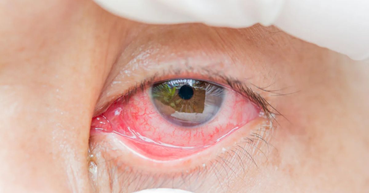 Nhiễm trùng mắt cũng có thể dẫn đến tình trạng viêm giác mạc