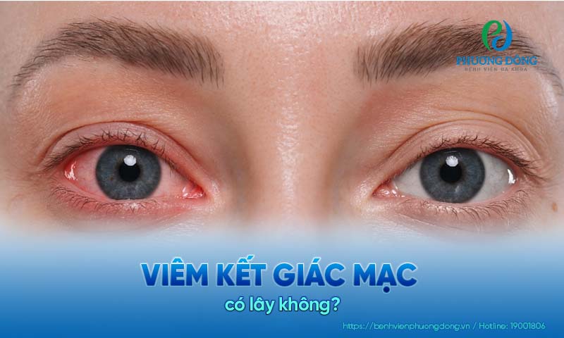 Bệnh nhân hỏi: Viêm kết giác mạc có lây không?