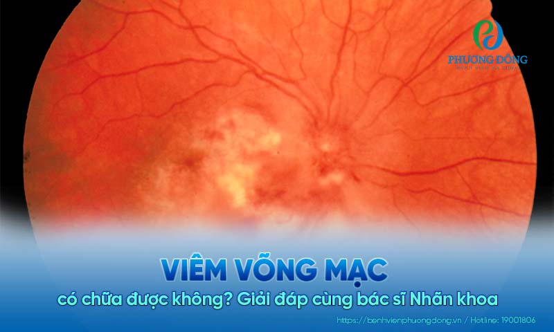 Giải đáp cùng bác sĩ Nhãn khoa: Viêm võng mạc có chữa được không?