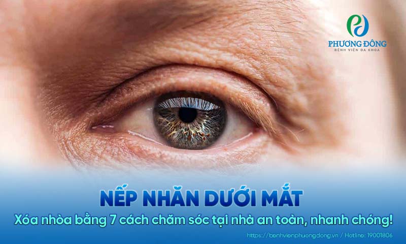 Xóa nhòa nếp nhăn dưới mắt bằng 7 cách chăm sóc tại nhà an toàn, nhanh chóng! 