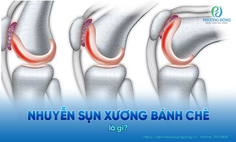 Nhuyễn sụn xương bánh chè: Nguyên nhân, triệu chứng và hướng điều trị
