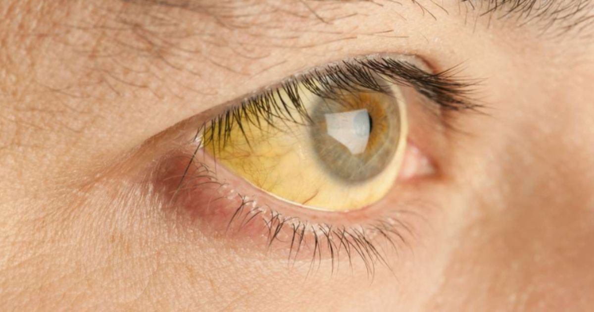 Nếu niêm mạc mắt mất màu đi kèm vàng mắt, bạn nên đi thăm khám sớm