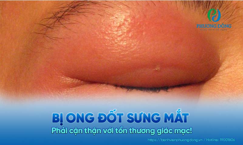 Bị ong đốt sưng mắt: Phải cận thận với tổn thương giác mạc!