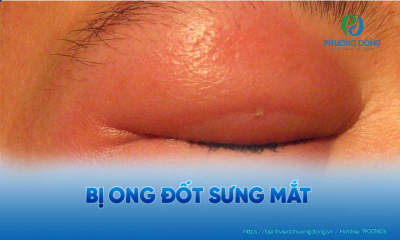 Triệu chứng sưng phù ở mắt sau khi bị ong đốt đôi khi không thể xử lý tại nhà