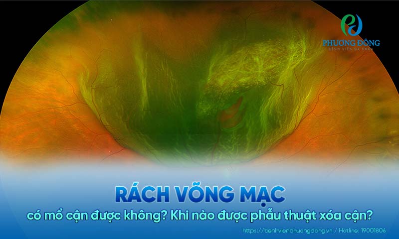 Rách võng mạc có mổ cận được không? Khi nào được phẫu thuật xóa cận? 