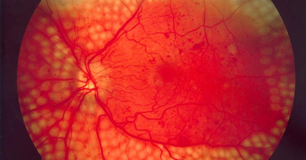 Cách điều trị rách võng mạc phổ biến nhất là laser quang đông 