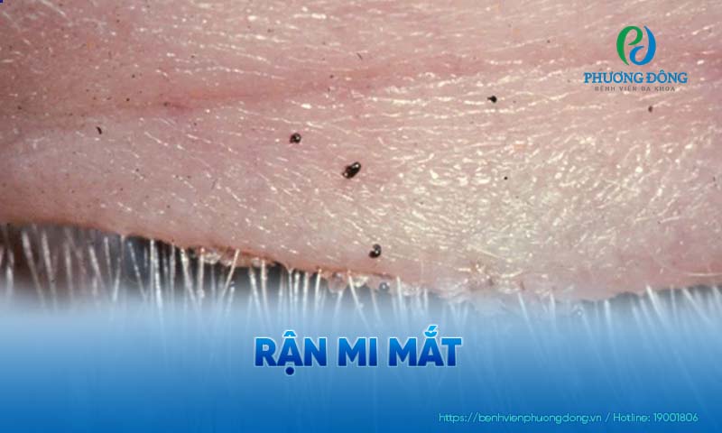 Mi mắt có rận thường gặp ở người vệ sinh cá nhân chưa đúng cách 