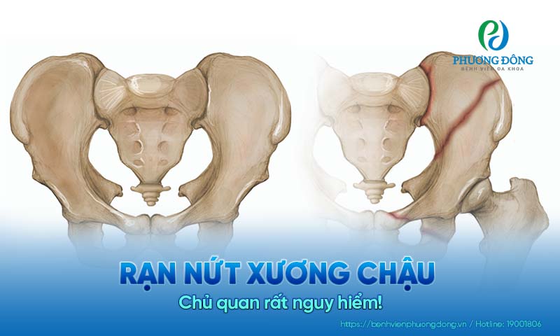 Rạn nứt xương chậu​ - Chủ quan rất nguy hiểm! 