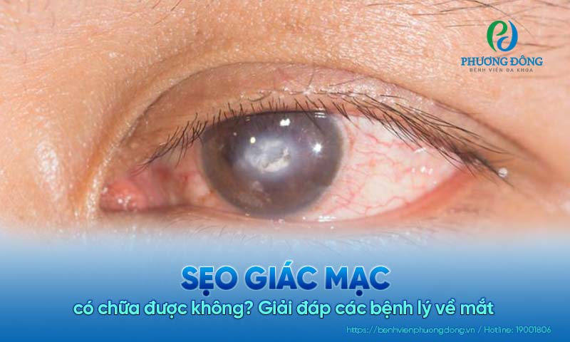 Giải đáp các bệnh lý về mắt : Sẹo giác mạc có chữa được không?