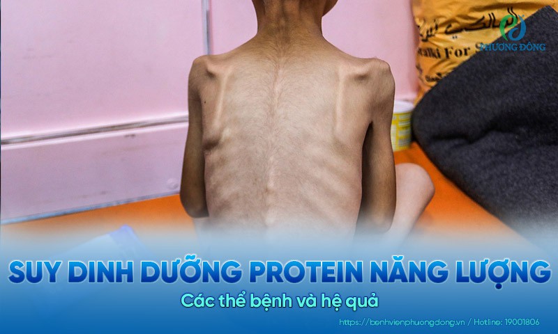 Suy dinh dưỡng protein năng lượng: Các thể bệnh và hệ quả