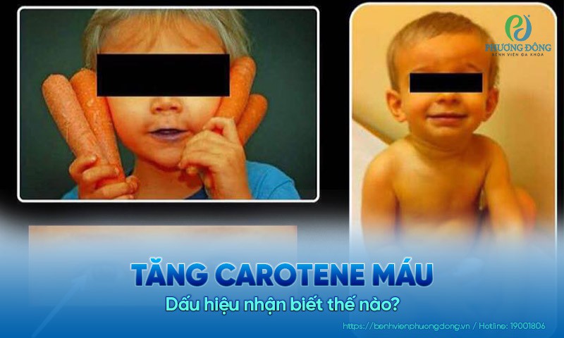 Tăng carotene máu là gì? Dấu hiệu nhận biết thế nào?