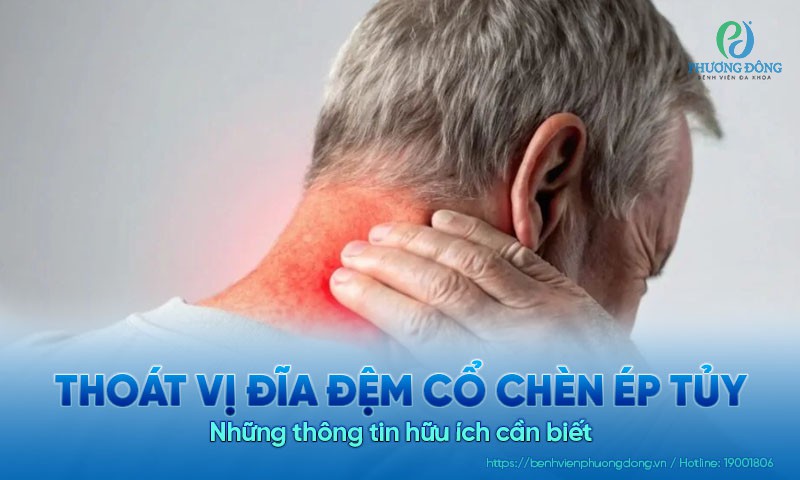 Thoát vị đĩa đệm cổ chèn ép tủy - Những thông tin hữu ích cần biết